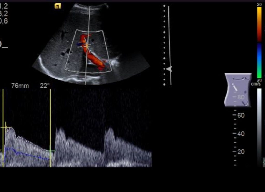 Ultraschall Leberarterie