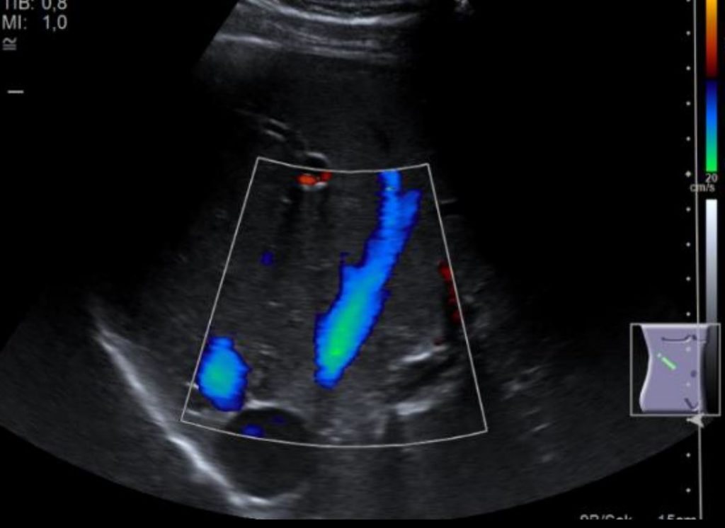 Ultraschall Lebervenen