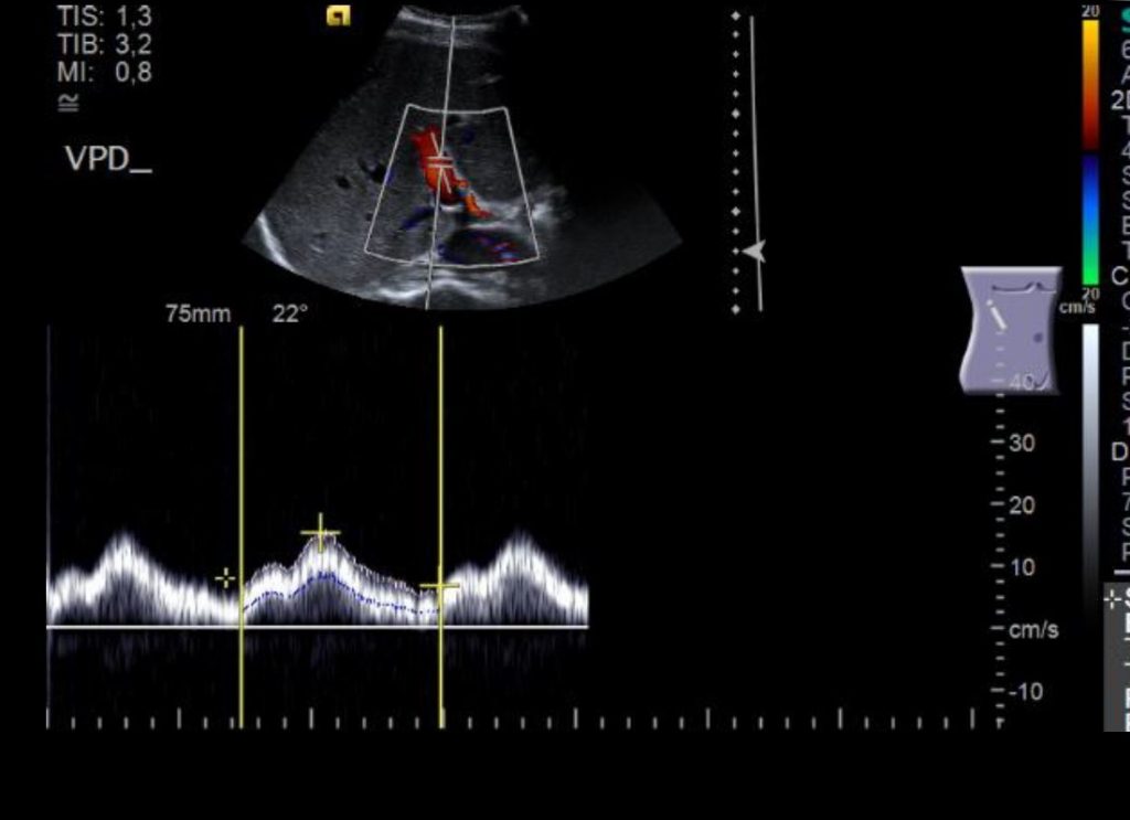 Ultraschall Pfortader